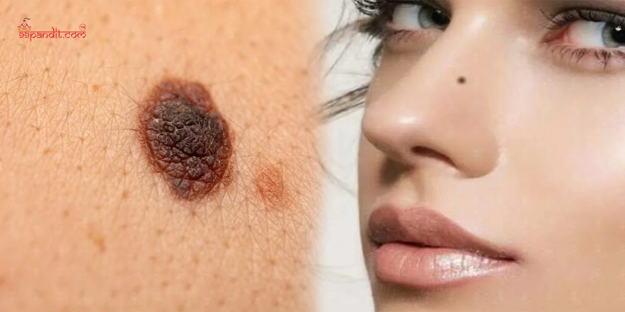 Moles on Body