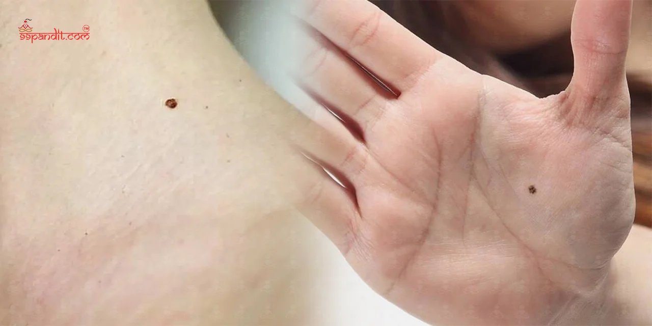 Moles on Body